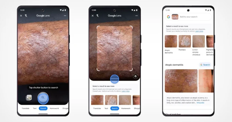 Google Lens agora pode identificar problemas de pele